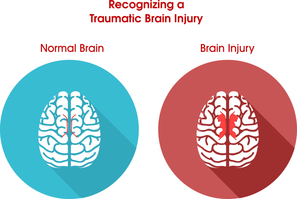 Recognizing A Traumatic Brain Injury