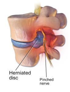 a herniated disc